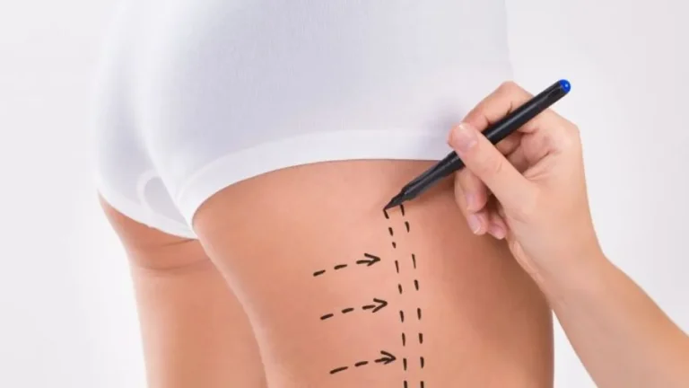 5 opções de tratamento estético para flacidez nas coxas
