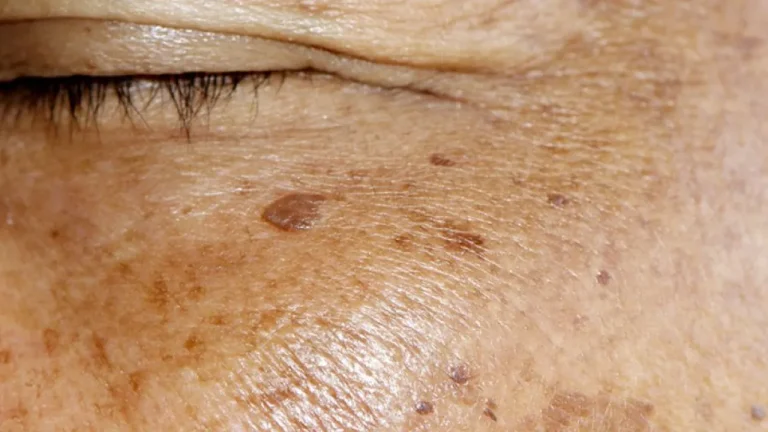 Manchas na pele: confira rotina de skincare para reduzir o Melasma