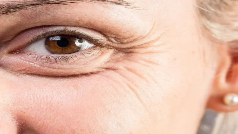 Rugas na área dos olhos: confira as principais dicas para reduzir